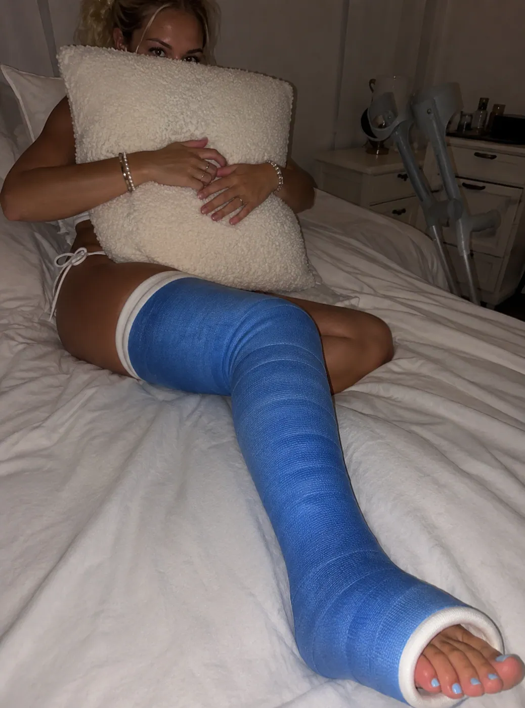 Example AI-generated leg cast photo made with Castlife Studio