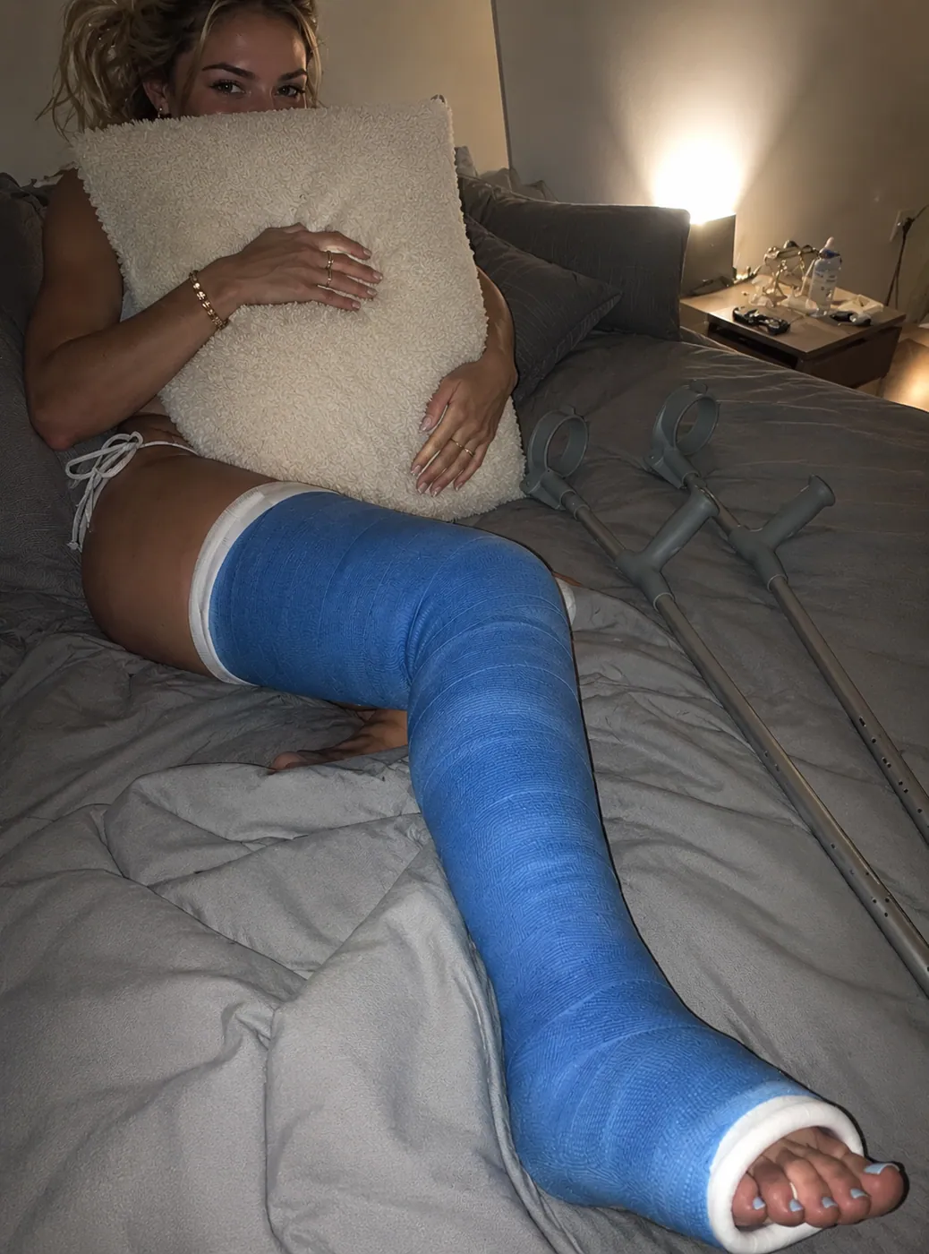Example AI-generated leg cast photo made with Castlife Studio