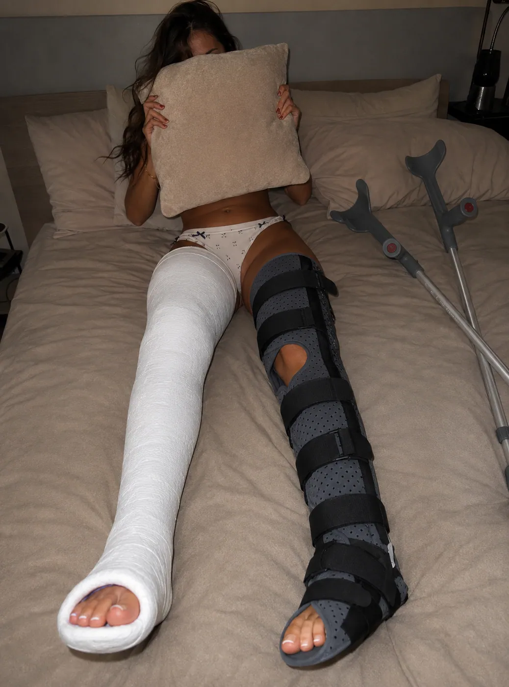 Example AI-generated leg cast photo made with Castlife Studio